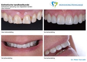 Mondzorg Hongarije - esthetische tandheelkunde