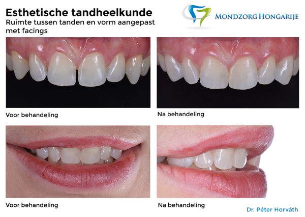 Esthetische Tandheelkunde - Mondzorg Hongarije