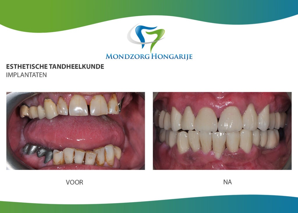 Brug op implantaten