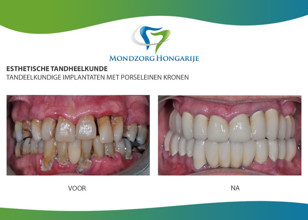 Complete gebitsrenovatie buitenland