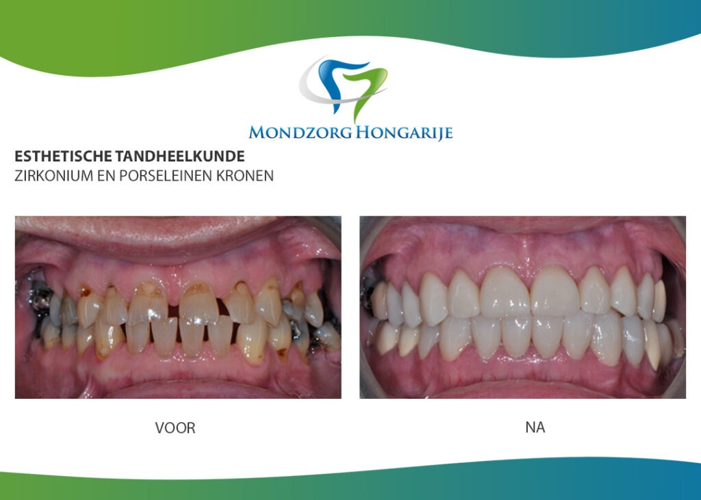 Gebit met implantaten