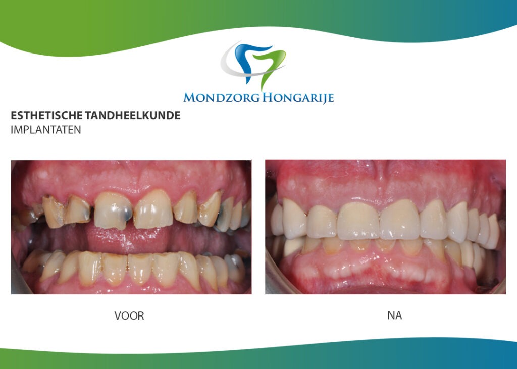 Tandenknarsen voor na met implantaten