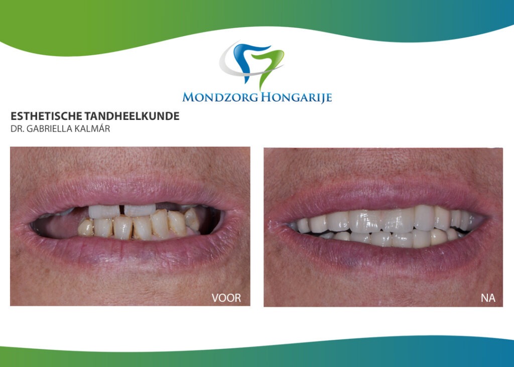 Tandarts bruggen