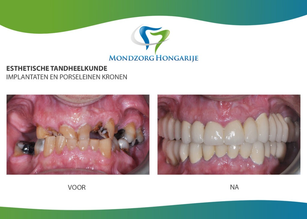 Complete renovatie gebit